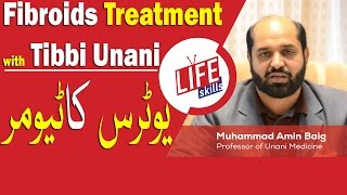 Fibroids Treatment with Tibbi Unani in UrduHindi  Life Skills TV [upl. by Tevlev]