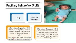 Pupillary Light Reflex  Pediatrics [upl. by Ennovi]