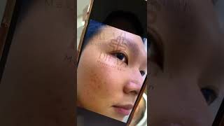 Pitted scar treatment covangdrazi acne pimples blackheads scartreatment [upl. by Chilcote]