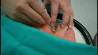 Retrobulbar injection for cataract surgery anesthesia [upl. by Bertold]