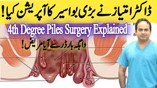 Operation of 4th Degree Piles  Haemorrhoidectomy of very big Piles  Surgeon Dr Imtiaz Hussain [upl. by Nahtanoj]