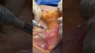 BLOODLESS TUMMY TUCK amp UMBILICAL HERNIA REPAIR BY DR GABRIEL PATINO 06 17 2024 5105257999 [upl. by Neely]