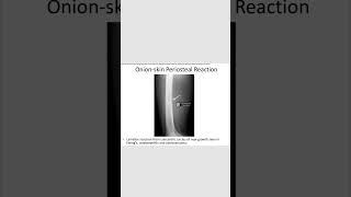 Onion skin periosteal reactionrevision neetpg inicet [upl. by Letnahs]