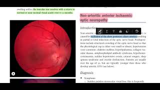 Kanski Clinical Ophthalmology Made Easy  neuro ophthalmology 6 ischemic optic neuropathy [upl. by Alida]