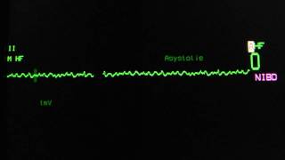 ventricular fibrillation on an ECG heart monitor [upl. by Ainekahs]