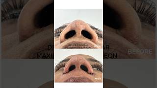 Alarplasty cosmetic surgery cochin alarplasty drvarunnambiar [upl. by Raine]