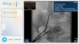 Sacroiliac Joint Rhizotomy for Sacroiliitis [upl. by Hiamerej]