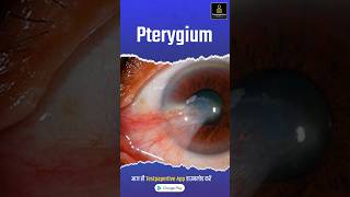 What Is A Pterygium  What is Pterygium in Hindi Pterygium PterygiuminHindi shorts eye [upl. by Aiel]