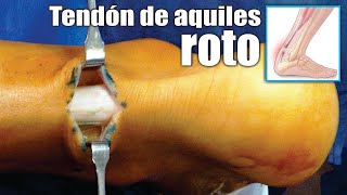 LESIONES del TENDÓN de AQUILES 🦶🏼 Causas Síntomas Tratamiento y Cirugía ⭐ Dr EDSON SERRANO Neomedica [upl. by Rennat]