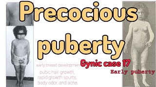 Precocious puberty gyniccase17 [upl. by Rogerson]