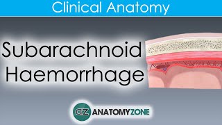 What is Subarachnoid Haemorrhage  Clinical Anatomy [upl. by Thoer333]