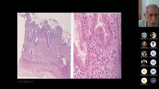 8 Colecistits aguda y crónica colelitiasis tumores de vesícula biliar y conductos biliares [upl. by Llehsar]