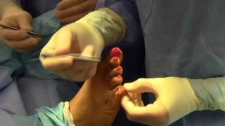 Hammer Toe 5th Digit Surgery  Dr Nagler  Spanish [upl. by Reamonn]