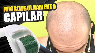 Microagulhamento capilar masculino funciona Usei com minoxidil [upl. by Enilram]