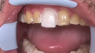 Houston Cosmetic DentistStep by step procedure for Porcelain VeneersConservative preps [upl. by Alburg]