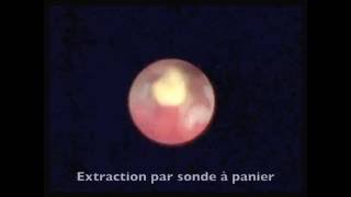 Sialendoscopie extraction par sonde à panier dune lithiase flottante [upl. by Henarat]