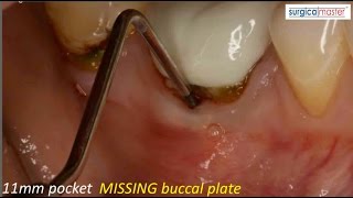 How to handle an 11mm pocket on the buccal [upl. by Ylecic976]