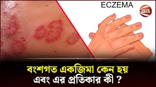 বংশগত একজিমা কেন হয় এবং এর প্রতিকার কী   Health Tips  Skin Care  Eczema  Channel 24 [upl. by Hertha]