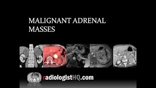 Malignant Adrenal Masses [upl. by Uv978]