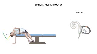 SemontPlus Maneuver for Right Posterior Canal Benign Paroxysmal Positional Vertigo [upl. by Sayres883]