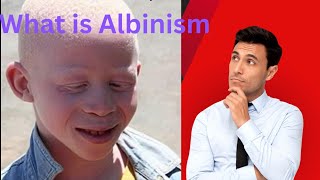 What is Albinism Albinism ratio in children Albinism definition Health Slash [upl. by Aicined210]