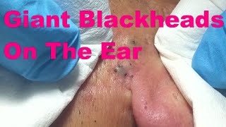 Giant Blackheads  Part I [upl. by Eimmac119]