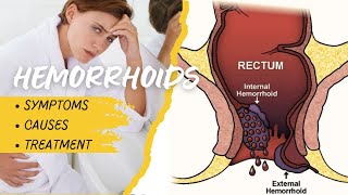 Eliminate Hemorrhoid Pain Causes Symptoms and Expert Treatments by Dr Shiraz Farooq [upl. by Duomham276]