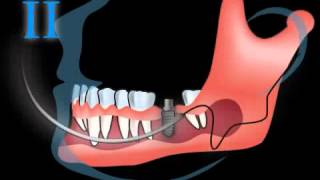 Live OP wie wird ein Zahnimplantat gesetzt  Implantation [upl. by Sophey]