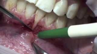 greffe de gencive  greffe gingivale libre [upl. by Ellary]