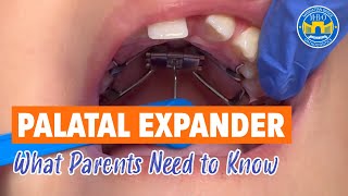 8 Things to Know About Palatal Expander [upl. by Wallache]