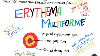 Erythema Multiforme EM causes symptoms treatment  skin disorder [upl. by Spindell]