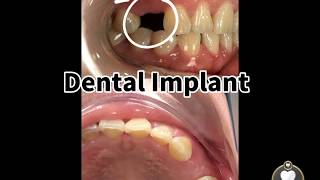 Dr Chloe Lim  Dental Implant [upl. by Alodee54]