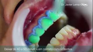 Clareamento Dental de Consultório com Whiteness HP Automixx da FGM [upl. by Linc780]