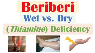 Beriberi Thiamine Deficiency Wet vs Dry Beriberi Pathophysiology Symptoms Diagnosis Treatment [upl. by Anafetse]