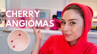 Cherry Angiomas How To Treat Them  Demo  Dr Shereene Idriss [upl. by Nivar]