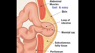 Femoral Umbilical amp Epigastric hernias [upl. by Evets]