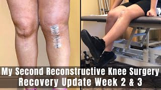 My Second Reconstructive Knee Surgery  Week 2 amp 3 Recovery Update  TTO MPFL amp Lateral Lengthening [upl. by Cline19]