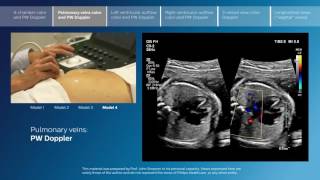 Advanced screening views of the fetal heart  Part 2  Pulmonary veins color and PW Doppler [upl. by Luanni]