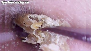 Ear Wax Removal 170 He was tormented by itchy ears every night  Ear Cleaning ASMR [upl. by Euk]