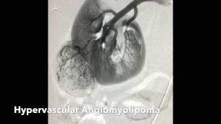 Renal Angiomyolipoma AML Transcatheter Ethanol Alcohol Embolization [upl. by Roda925]