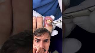 A UNHA TRANSPASSOU A PELE  ingrownhairremoval podologia unhaencravada nails foryou [upl. by Dougherty510]