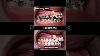 Braces are very crooked teeth braces orthodontist dentistry dentist allaboutbraces [upl. by Angell240]