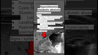 Hypochloremic metabolic alkalosis [upl. by Ahsekyt143]