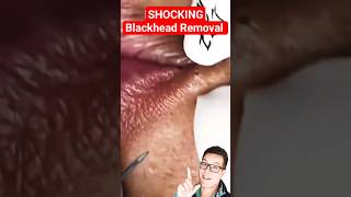 SURPRISING BLACKHEAD REMOVAL  Where Did It All Come From shorts [upl. by Ader]