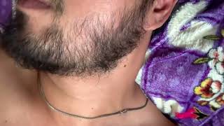 2 Years After Stop to use Minoxidil for Beard Growth [upl. by Nnylsor]