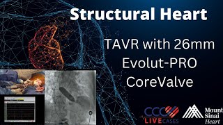 TAVR with 26mm EvolutPRO CoreValve  May 8 2018 [upl. by Burke]