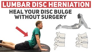 How to Heal Your Disc Herniation Without Surgery [upl. by Nowad187]