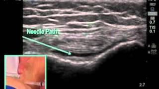 How to Ultrasound Guided Knee Injection Scanning Technique [upl. by Adnol]