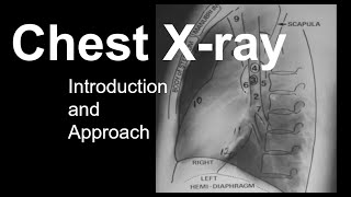 Chest Xray Introduction and Approach [upl. by Essile]