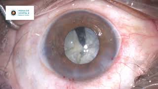 Mature Cataract Phacoemulsification  Small Pupil Phaco  Dr Ashish K Jain  MEHRC Mumbai [upl. by Nossila]